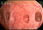 Diverticulos